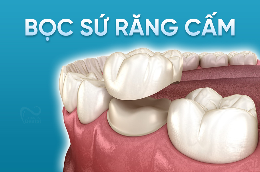 Bọc răng sứ răng số 7: Cách chọn lựa và quy trình thực hiện hiệu quả