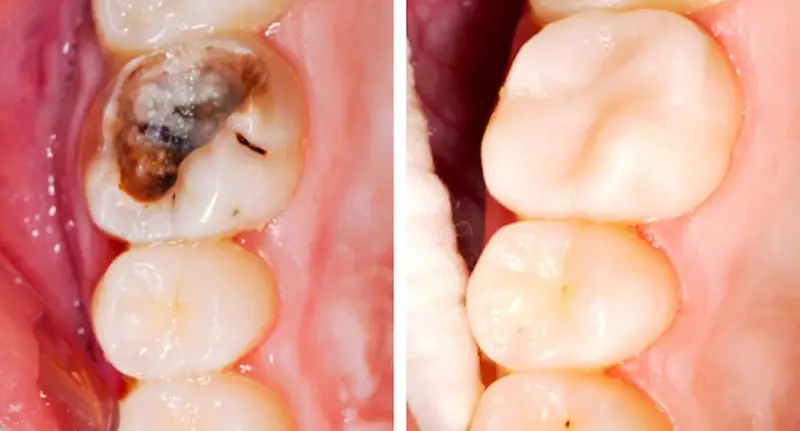 Chi Phí Trám Răng Số 7 Yếu Tố Ảnh Hưởng