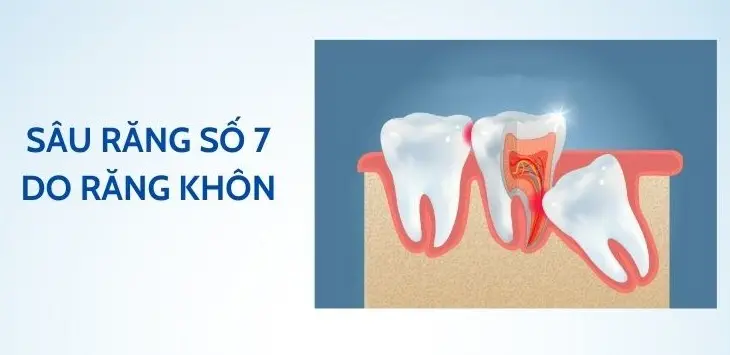Chi Phí Trám Răng Số 7 Yếu Tố Ảnh Hưởng