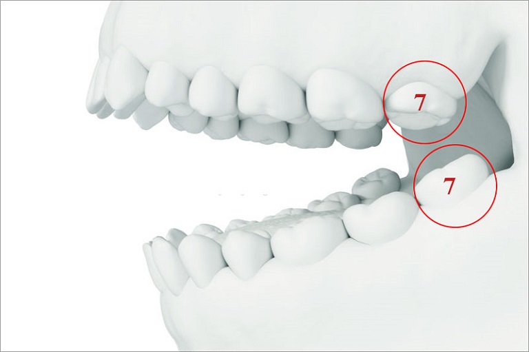 Mất răng số 7 hàm trên/dưới: Khắc phục thế nào?