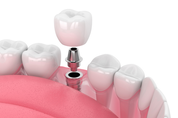 Mất răng số 7 hàm trên/dưới: Khắc phục thế nào?