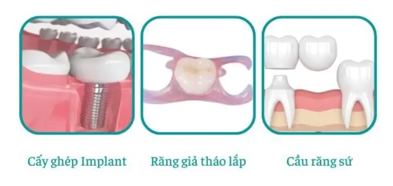 Mất răng số 7 hàm trên/dưới: Khắc phục thế nào?