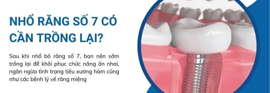Mất răng số 7 hàm trên/dưới: Khắc phục thế nào?