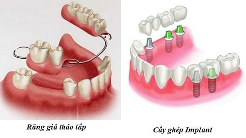 Mất răng số 7 hàm trên/dưới: Khắc phục thế nào?