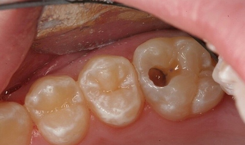 Răng số 7 bị ê buốt: Nguyên nhân và cách khắc phục hiệu quả