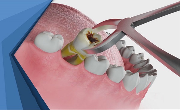 Răng số 7 bị ê buốt: Nguyên nhân và cách khắc phục hiệu quả