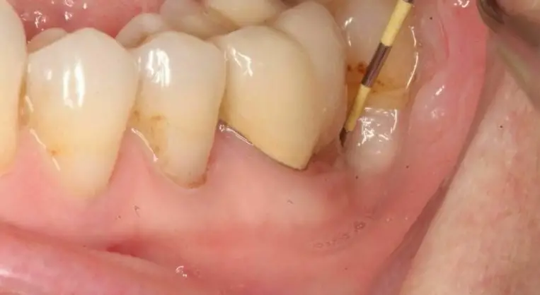 Răng số 7 bị ê buốt: Nguyên nhân và cách khắc phục hiệu quả