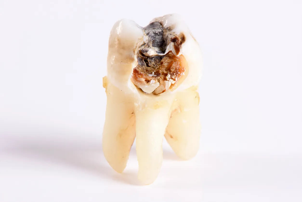 Răng số 7 gãy vỡ: Nguyên nhân, điều trị và chi phí