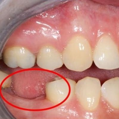 Răng Số 7 Là Răng Nào? Vị Trí, Chức Năng &Amp; Cách Chăm Sóc