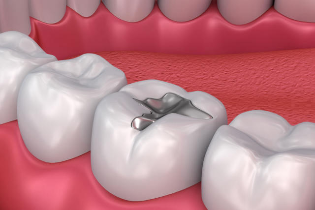 Chi Phí Trám Răng Số 7 Yếu Tố Ảnh Hưởng