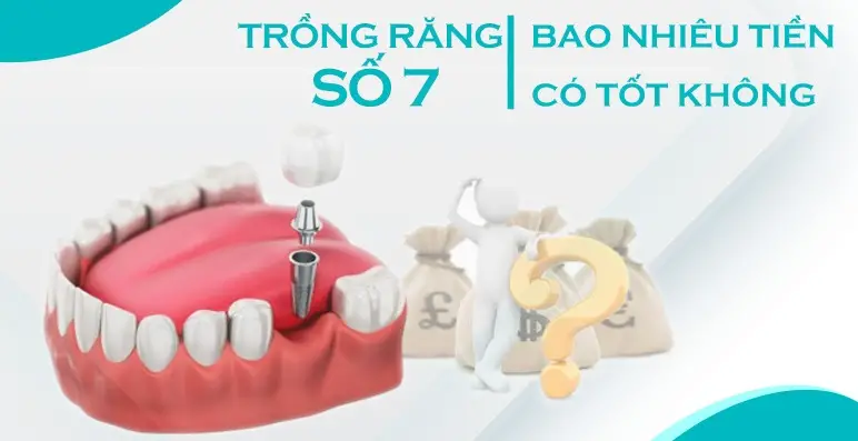 Trồng Răng Số 7 Hàm Trên/Dưới: So Sánh Chi Phí Phương Pháp