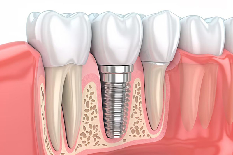 Trồng Răng Số 7 Hàm Trên/Dưới: So Sánh Chi Phí Phương Pháp