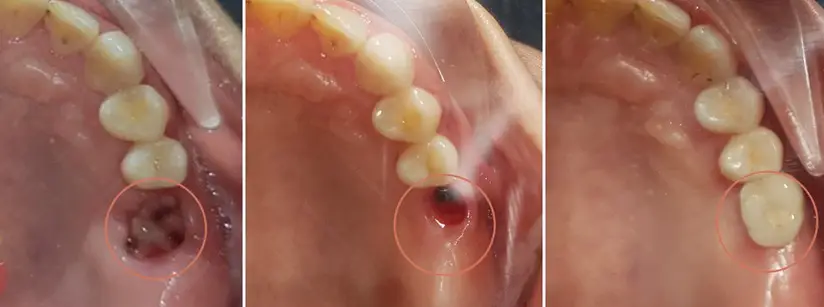 Trồng Răng Số 7 Hàm Trên/Dưới: So Sánh Chi Phí Phương Pháp