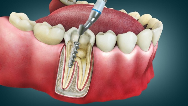 Viêm Tủy Răng Số 7: Nguyên Nhân, Triệu Chứng Điều Trị Hiệu Quả