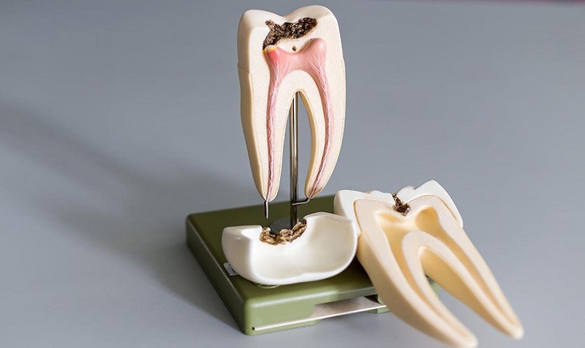 Viêm Tủy Răng Số 7: Nguyên Nhân, Triệu Chứng Điều Trị Hiệu Quả