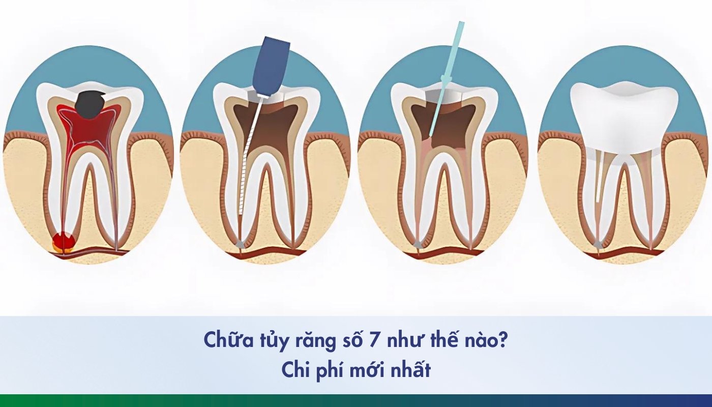 Viêm Tủy Răng Số 7: Nguyên Nhân, Triệu Chứng Điều Trị Hiệu Quả