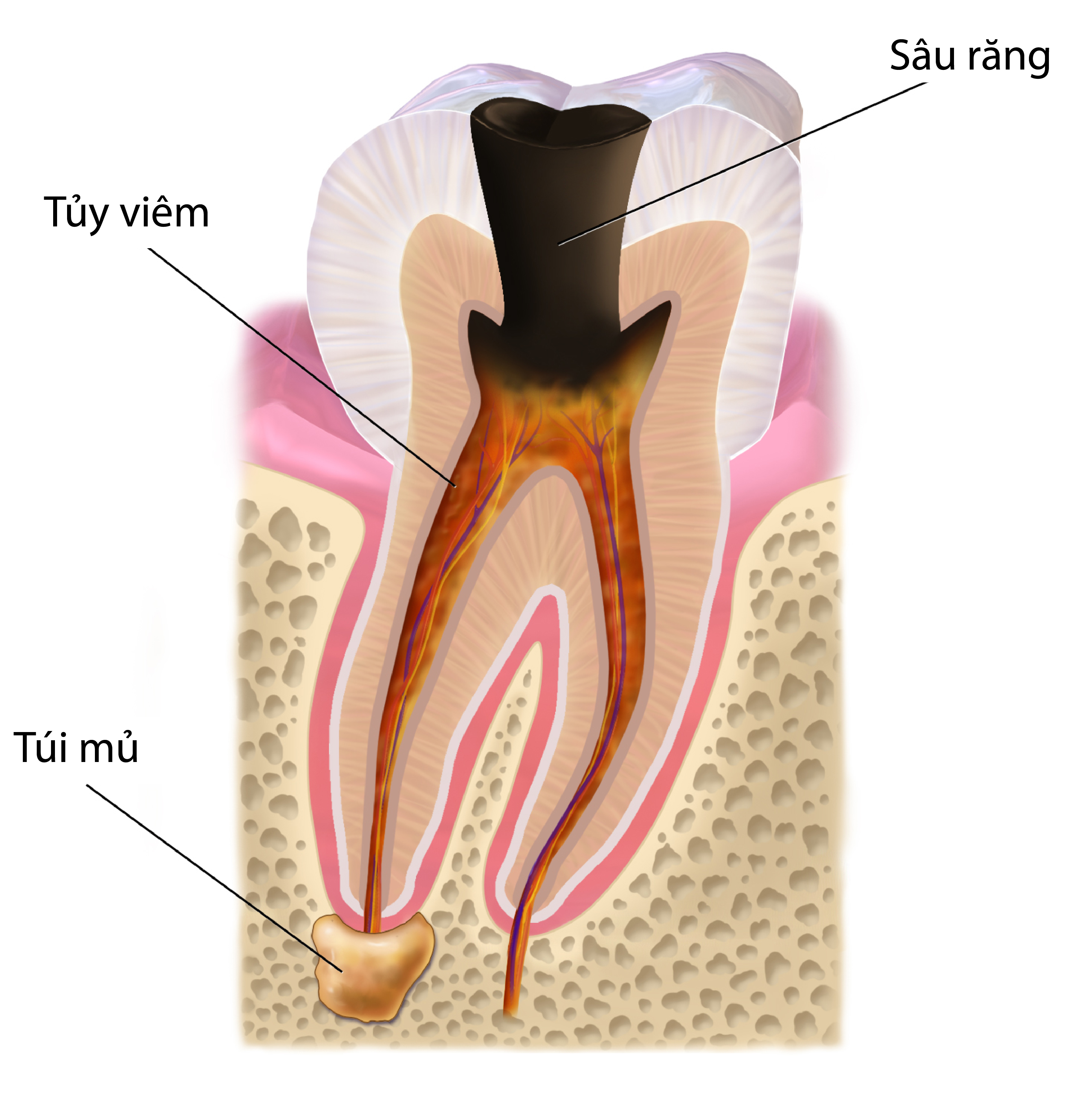 Viêm Tủy Răng Số 7: Nguyên Nhân, Triệu Chứng Điều Trị Hiệu Quả
