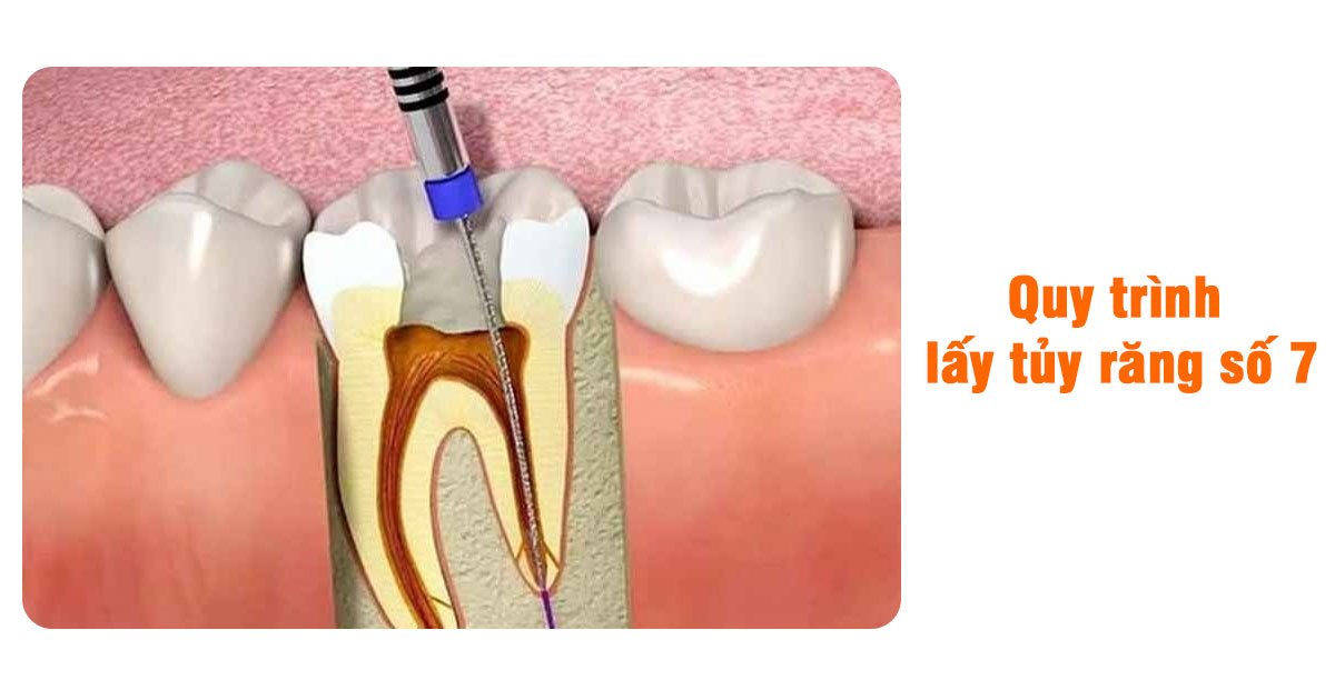 Viêm Tủy Răng Số 7: Nguyên Nhân, Triệu Chứng Điều Trị Hiệu Quả
