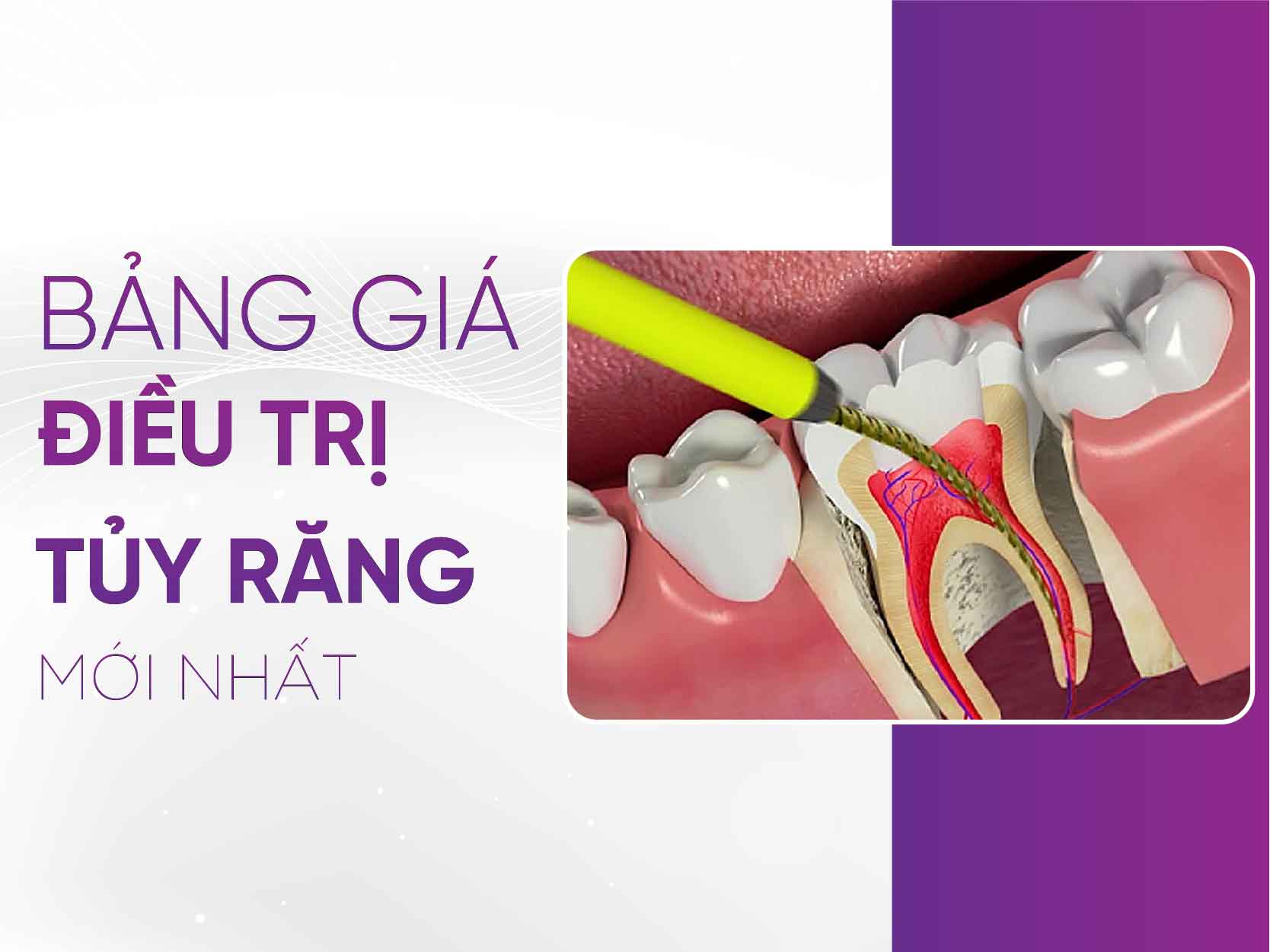 Bảng Giá Điều Trị Tủy Răng 2025