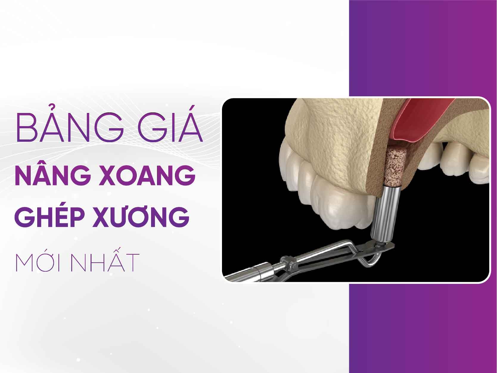Bảng Giá Nâng Xoang Ghép Xương 2025