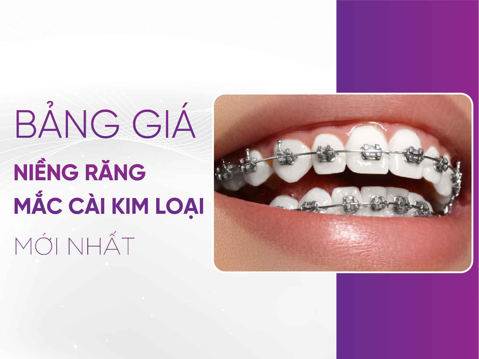 Bảng Giá Niềng Răng Mắc Cài Kim Loại 2025