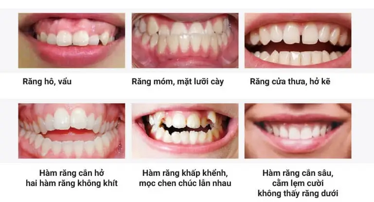 Bảng giá niềng răng mắc cài kim loại: Chi phí và thông tin cần biết năm 2023