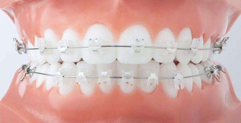 Bảng giá niềng răng mắc cài sứ 2025 Bảng Giá Niềng Răng Mắc Cài Sứ 2025