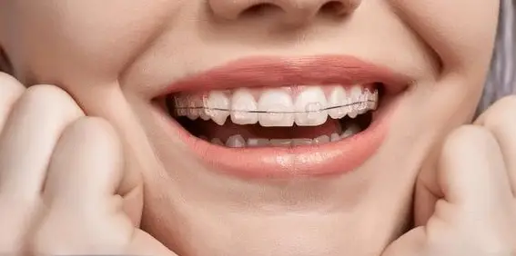 Bảng giá niềng răng mắc cài sứ 2025 Bảng Giá Niềng Răng Mắc Cài Sứ 2025