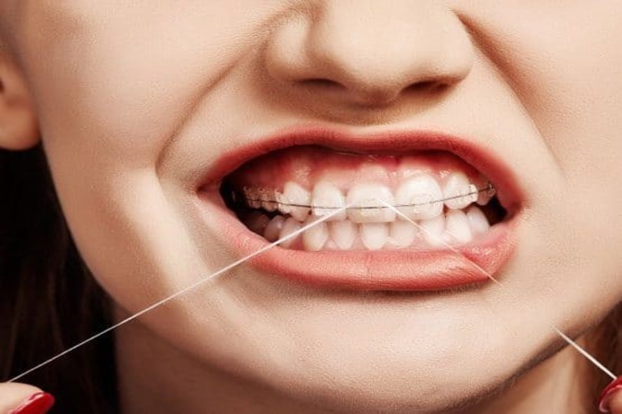 Bảng giá niềng răng mắc cài sứ 2025 Bảng Giá Niềng Răng Mắc Cài Sứ 2025