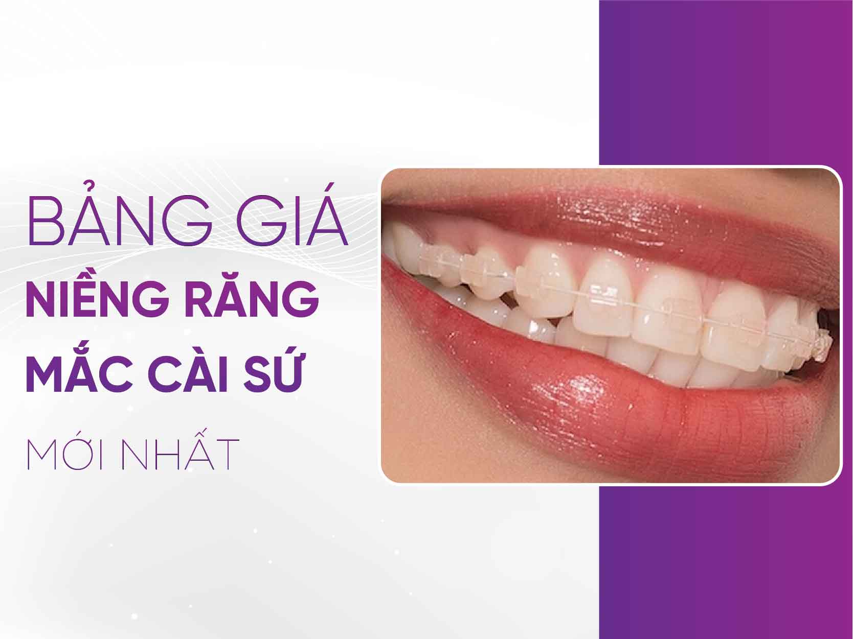 Bảng Giá Niềng Răng Mắc Cài Sứ 2025
