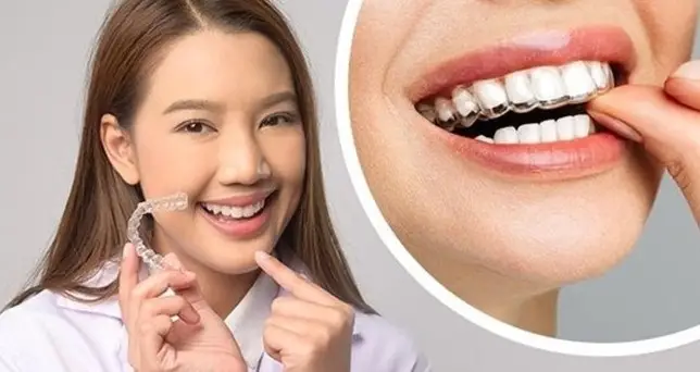 Bảng giá niềng răng trong suốt 2025