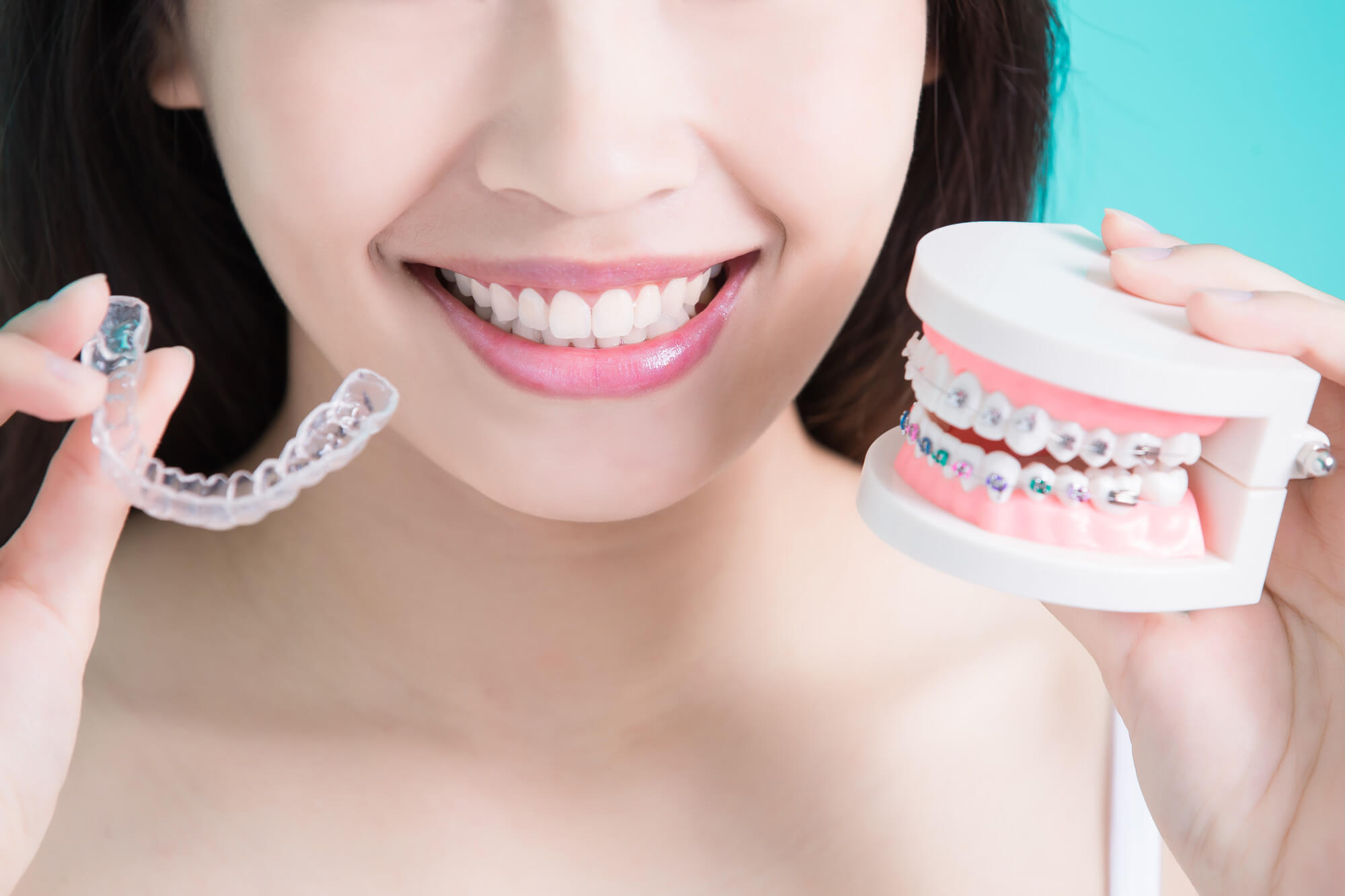 Bảng giá niềng răng trong suốt 2025