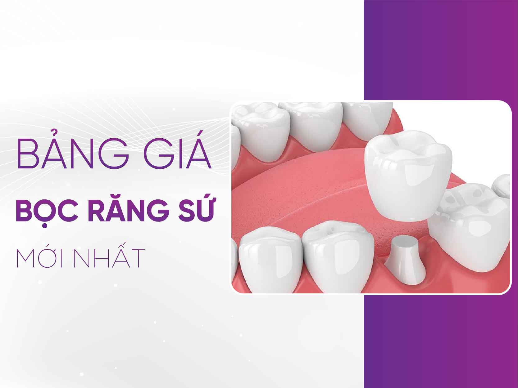 Bảng Giá Răng Sứ 2025: Cập Nhật Chi Tiết Tại Nha Khoa Otis