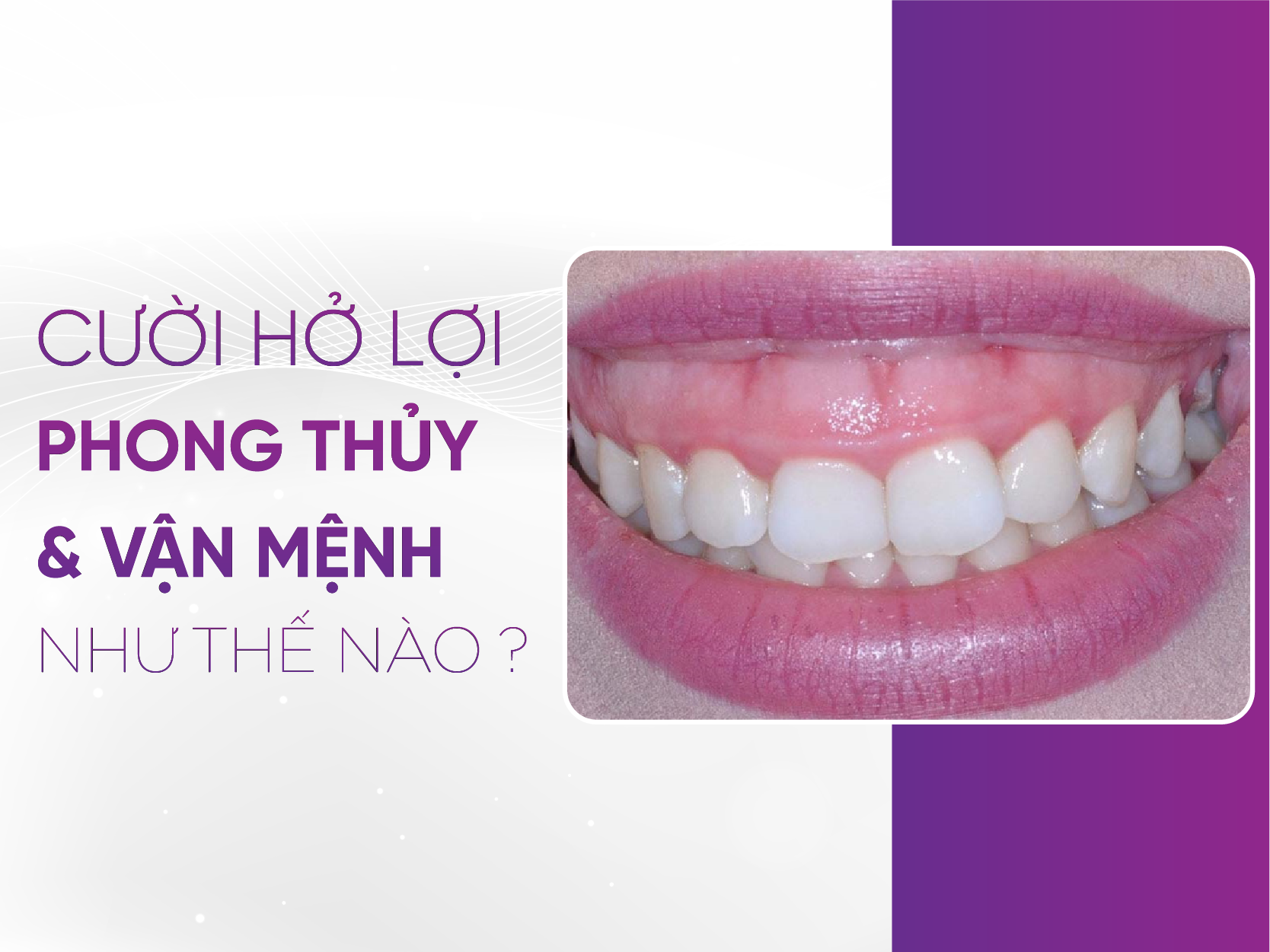 Cười Hở Lợi Tướng Số Nữ: Tốt Hay Xấu? 4 Cách Khắc Phục Hiệu Quả?