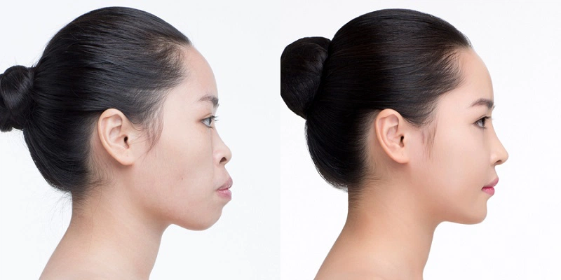 Mewing Đúng Cách - 3 Phương Pháp Tạo Nên Khuôn Mặt Cân Đối