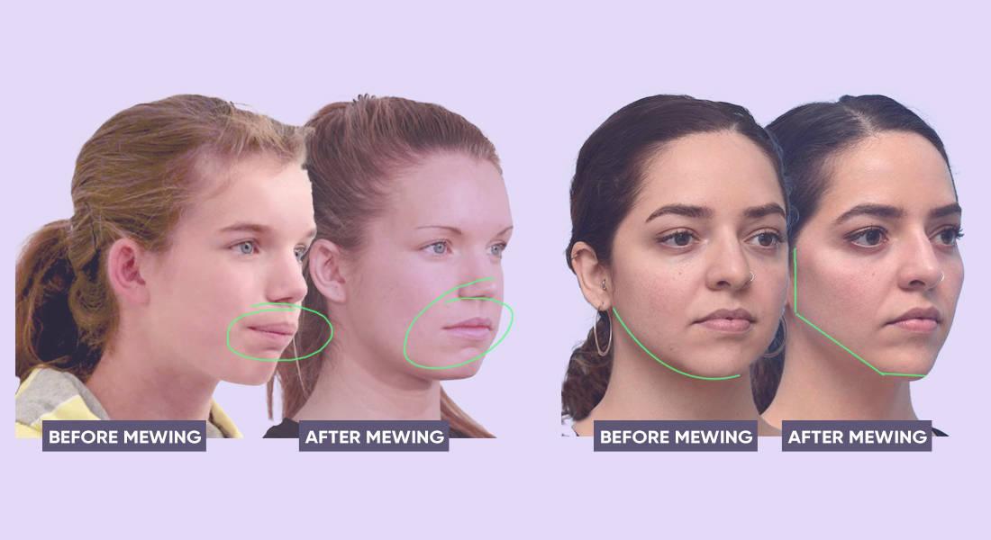 Mewing Đúng Cách - 3 Phương Pháp Tạo Nên Khuôn Mặt Cân Đối