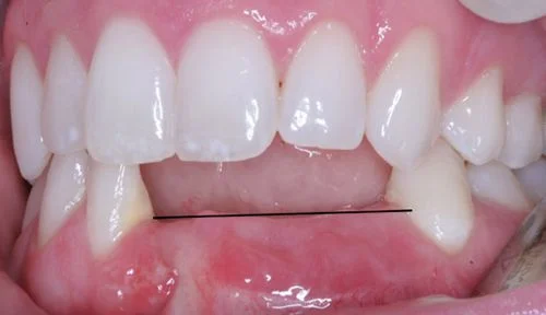 Mơ Gãy Răng - Giải Mã Những Ý Nghĩa Bí Ẩn Và Điềm Báo Tương Lai