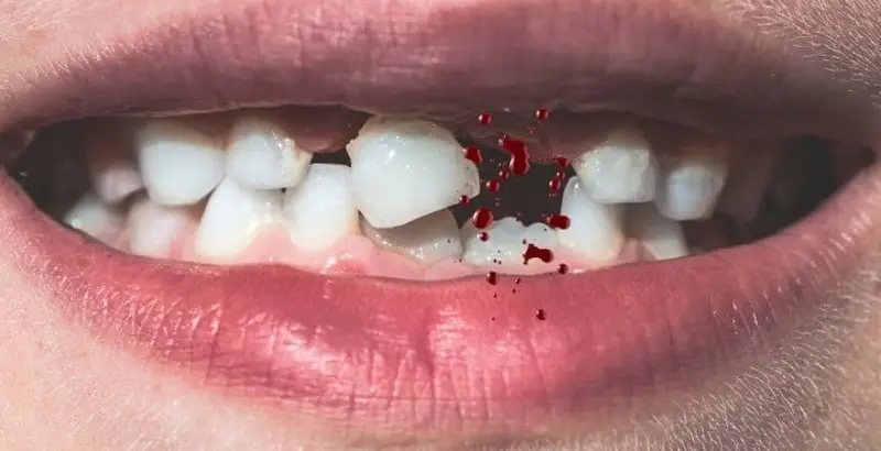 Mơ Gãy Răng - Giải Mã Những Ý Nghĩa Bí Ẩn Và Điềm Báo Tương Lai