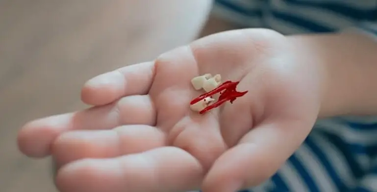Mơ Gãy Răng - Giải Mã Những Ý Nghĩa Bí Ẩn Và Điềm Báo Tương Lai