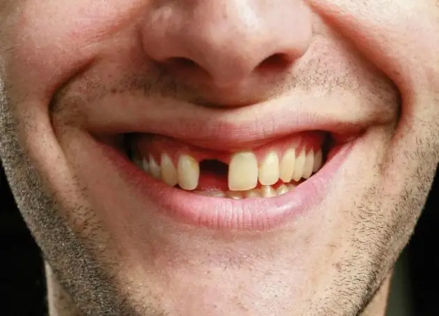 Mơ Gãy Răng - Giải Mã Những Ý Nghĩa Bí Ẩn Và Điềm Báo Tương Lai