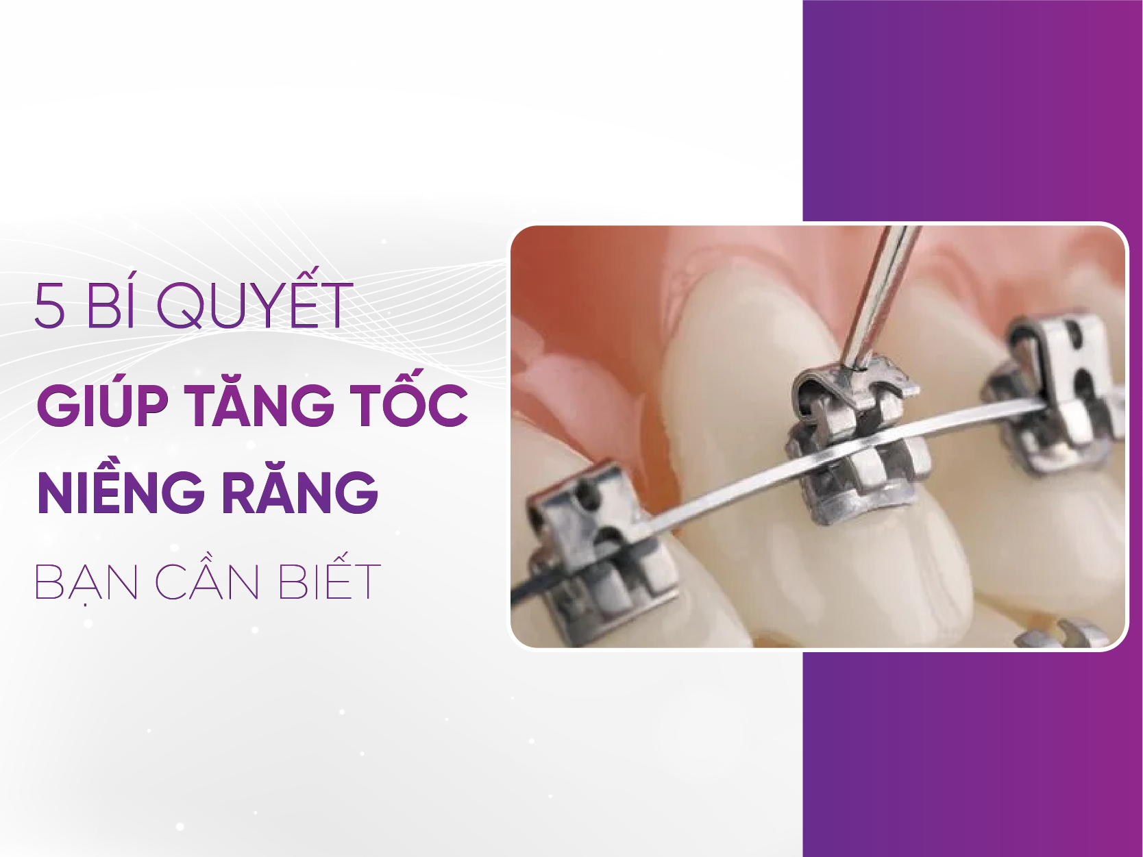 5 Bí Quyết Niềng Răng Nhanh - Sở Hữu Nụ Cười Rạng Rỡ