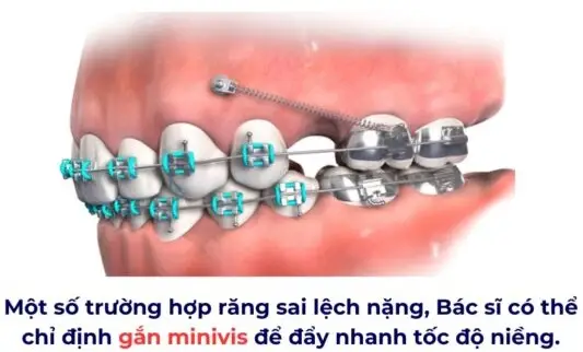 5 Bí Quyết Niềng Răng Nhanh - Sở Hữu Nụ Cười Rạng Rỡ