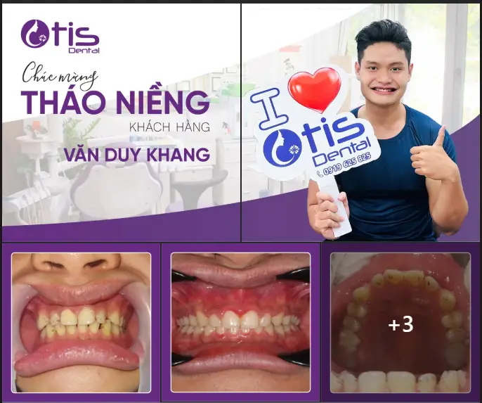 5 Bí Quyết Niềng Răng Nhanh - Sở Hữu Nụ Cười Rạng Rỡ