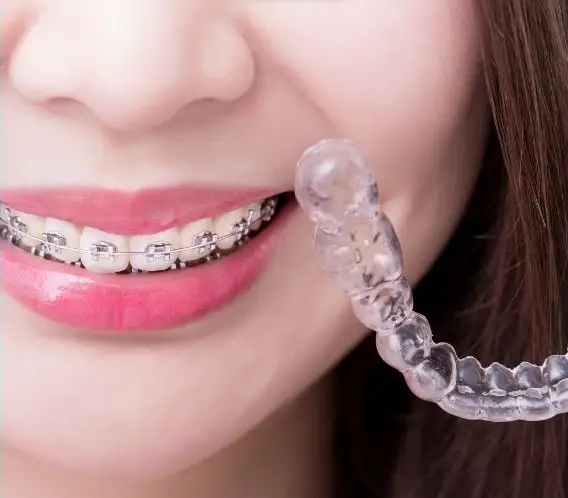 5 Bí Quyết Niềng Răng Nhanh - Sở Hữu Nụ Cười Rạng Rỡ