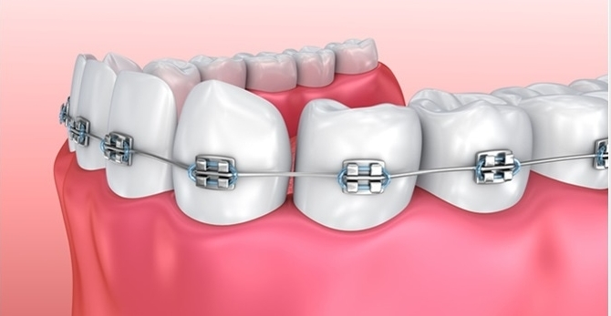 5 Bí Quyết Niềng Răng Nhanh - Sở Hữu Nụ Cười Rạng Rỡ