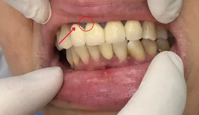 Bọc Răng Sứ Ê Buốt - Nguyên Nhân, Giải Pháp Tối Ưu