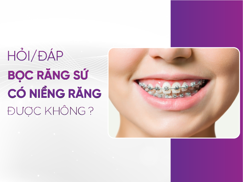 Bọc Răng Sứ Có Niềng Răng Được Không? - Giải Đáp Thắc Mắc Chi Tiết Bọc Răng Sứ Có Niềng Răng Được Không