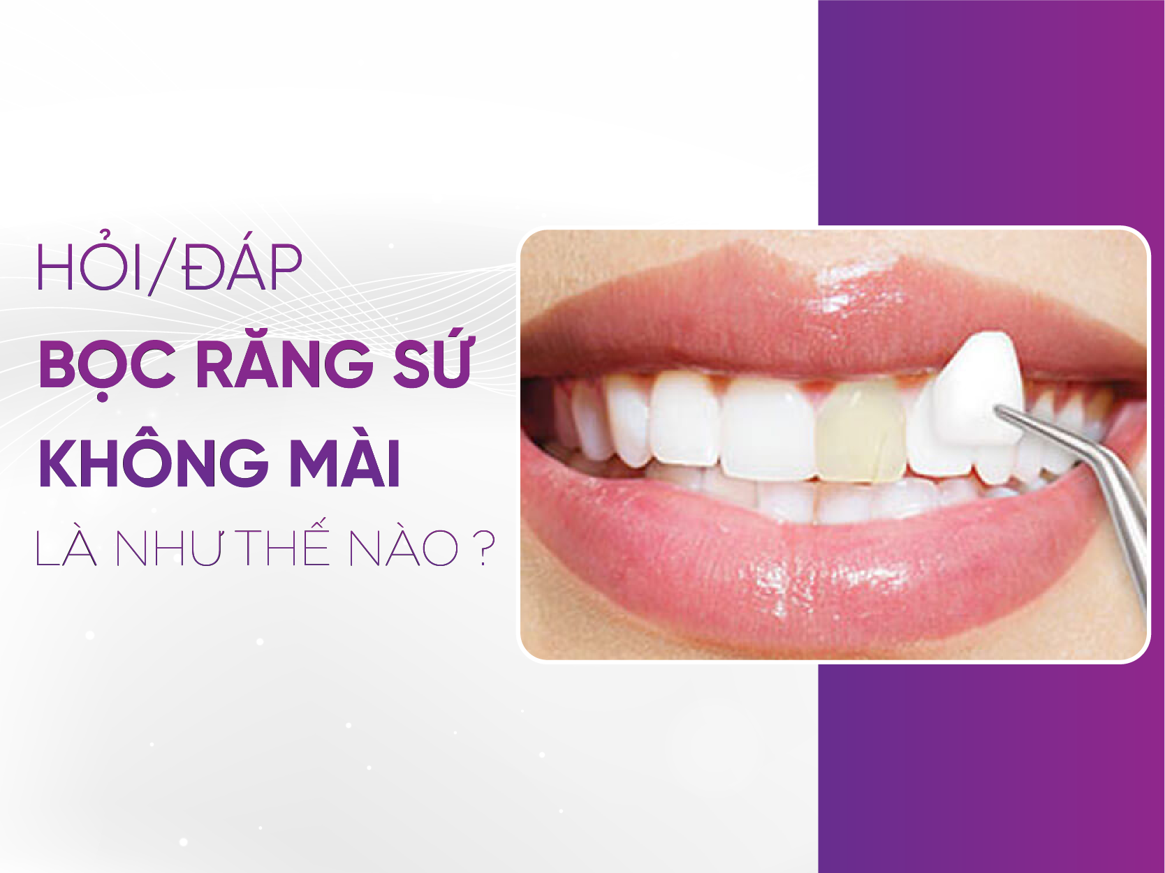 Bọc Răng Sứ Không Mài - Giải Pháp Thẩm Mỹ Hiệu Quả, An Toàn