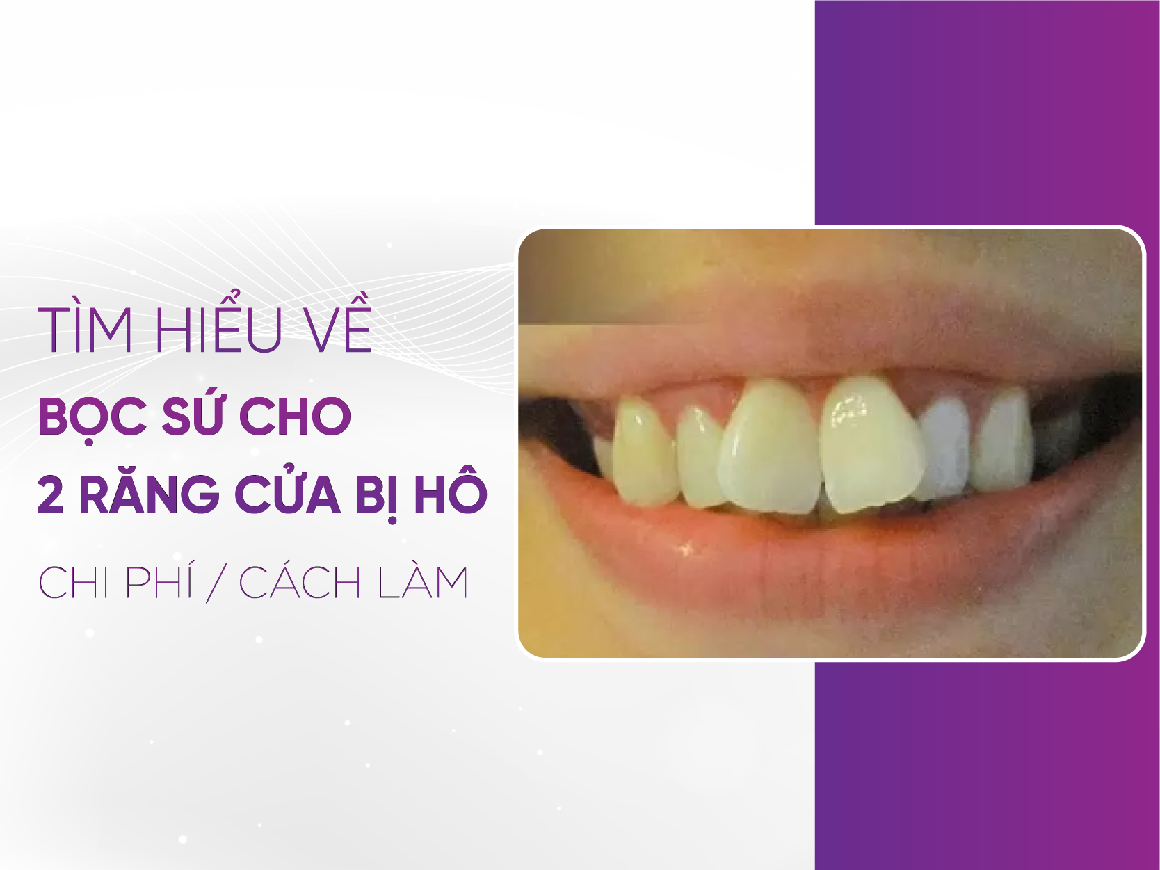 Bọc Sứ 2 Răng Cửa Bị Hô - Nụ Cười Tự Tin Trong Tầm Tay