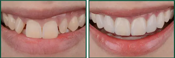 Bọc Sứ 2 Răng Cửa Bị Hô - Nụ Cười Tự Tin Trong Tầm Tay